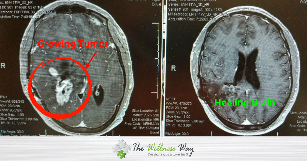 Healing Brain Tumor