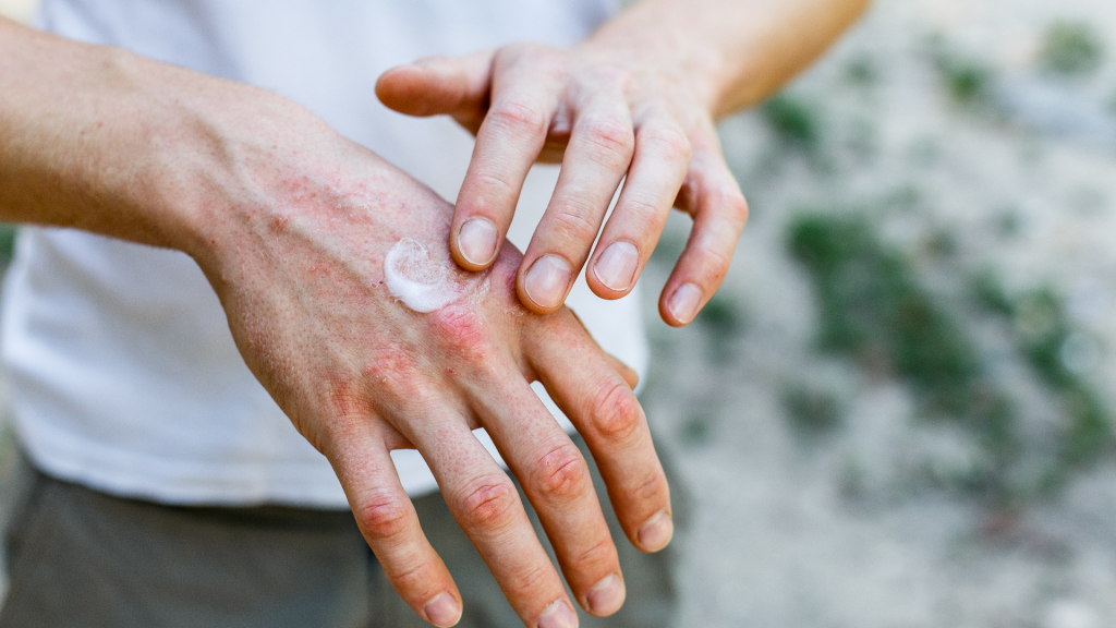 man applying lotion to rash on hands