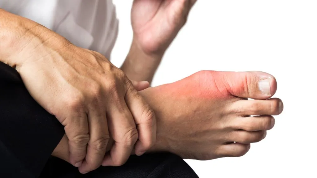 Man with painful and swollen right foot due to gout inflammation
